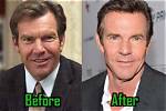 Dennis Quaid Plastic Surgery, Before After Pics – Age and Height Revealed