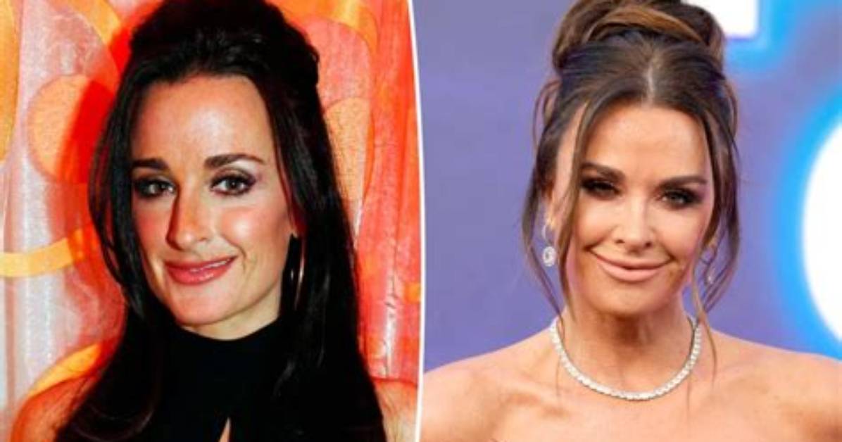 Kyle Richards’ Botox, Before and After Photos: Has She Done Nose Job and Lip Filler