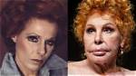 Ornella Vanoni Plastic Surgery Transformation over the Year's