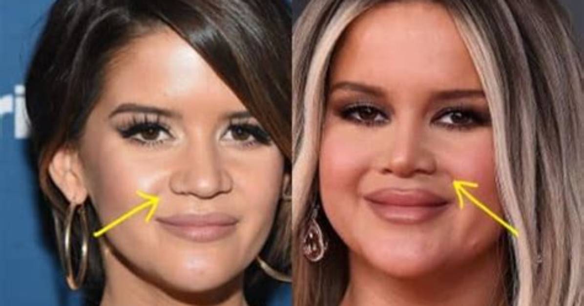 What Happened to Maren Morris Lips? Plastic Surgery Update, Before & After Photos from Instagram