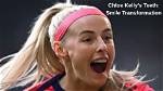 What Is Wrong with Chloe Kelly Teeth? Face and Nose Injury – Does She Use Braces?