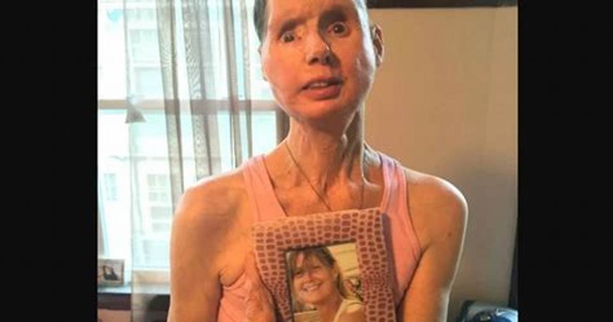 Where Is Charla Nash Now? Travis the Chimp Victim – Age Husband and Face Condition 2022